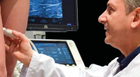 Scleroterapia ecoguidata delle vene varicose