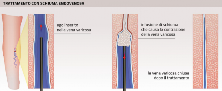 scleroterapia_04.png